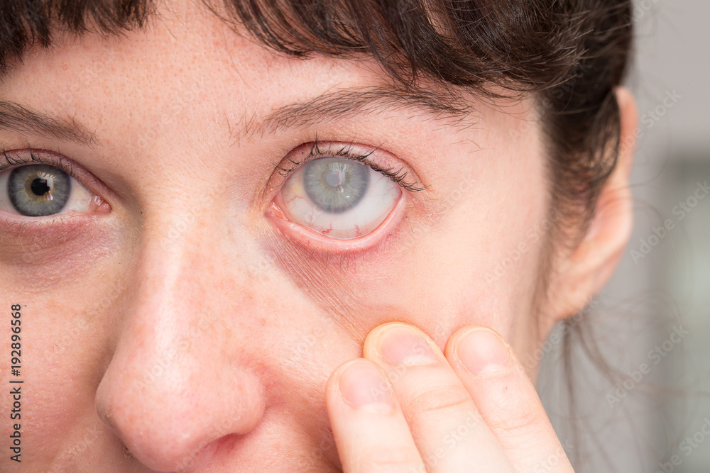 Corneal Opacity